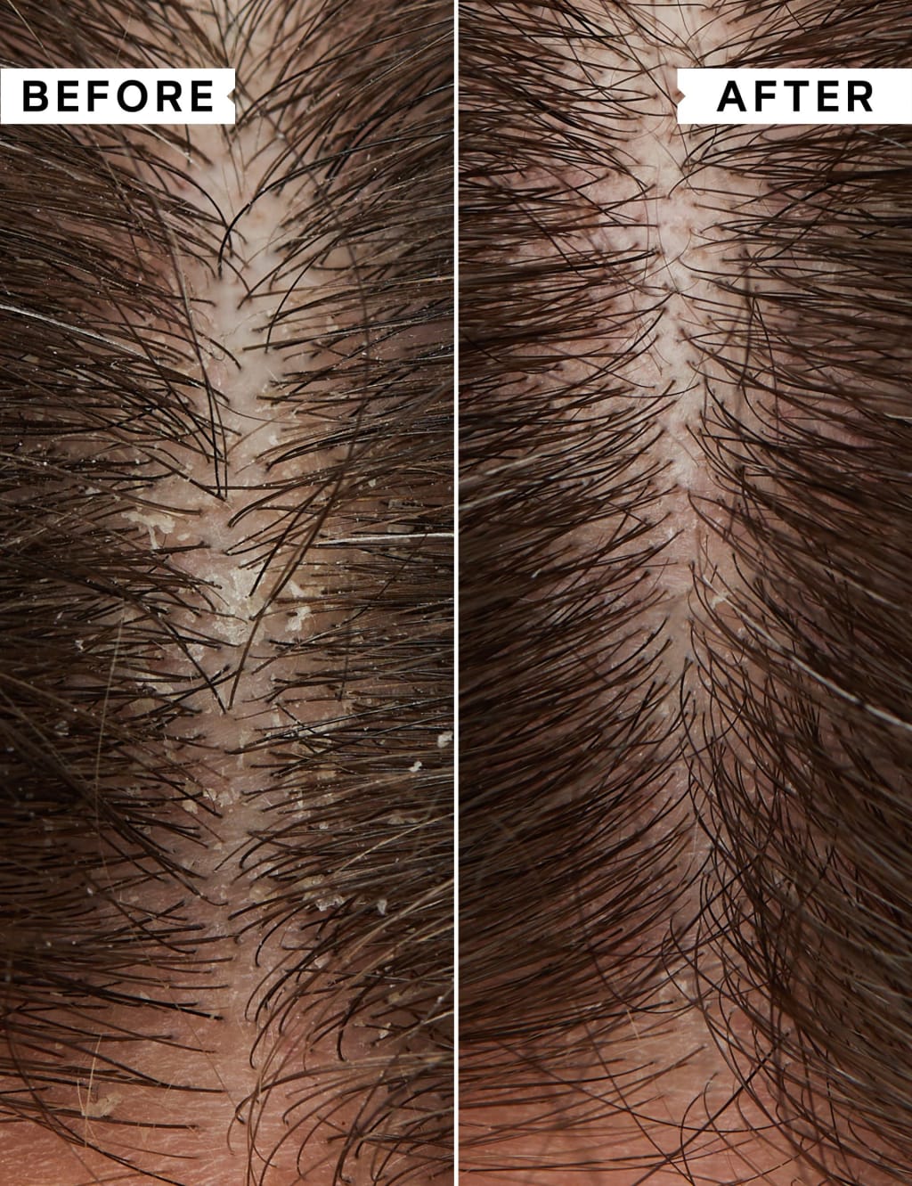 Flaky/Itchy Scalp Regime Kit 4 of 6