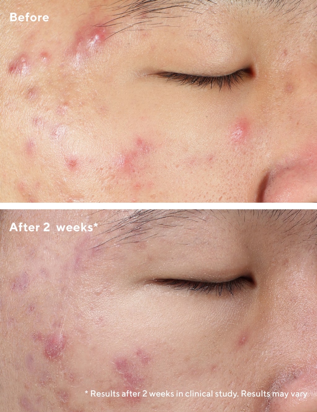 Deep Relief Blemish Treatment 30ml 2 of 7