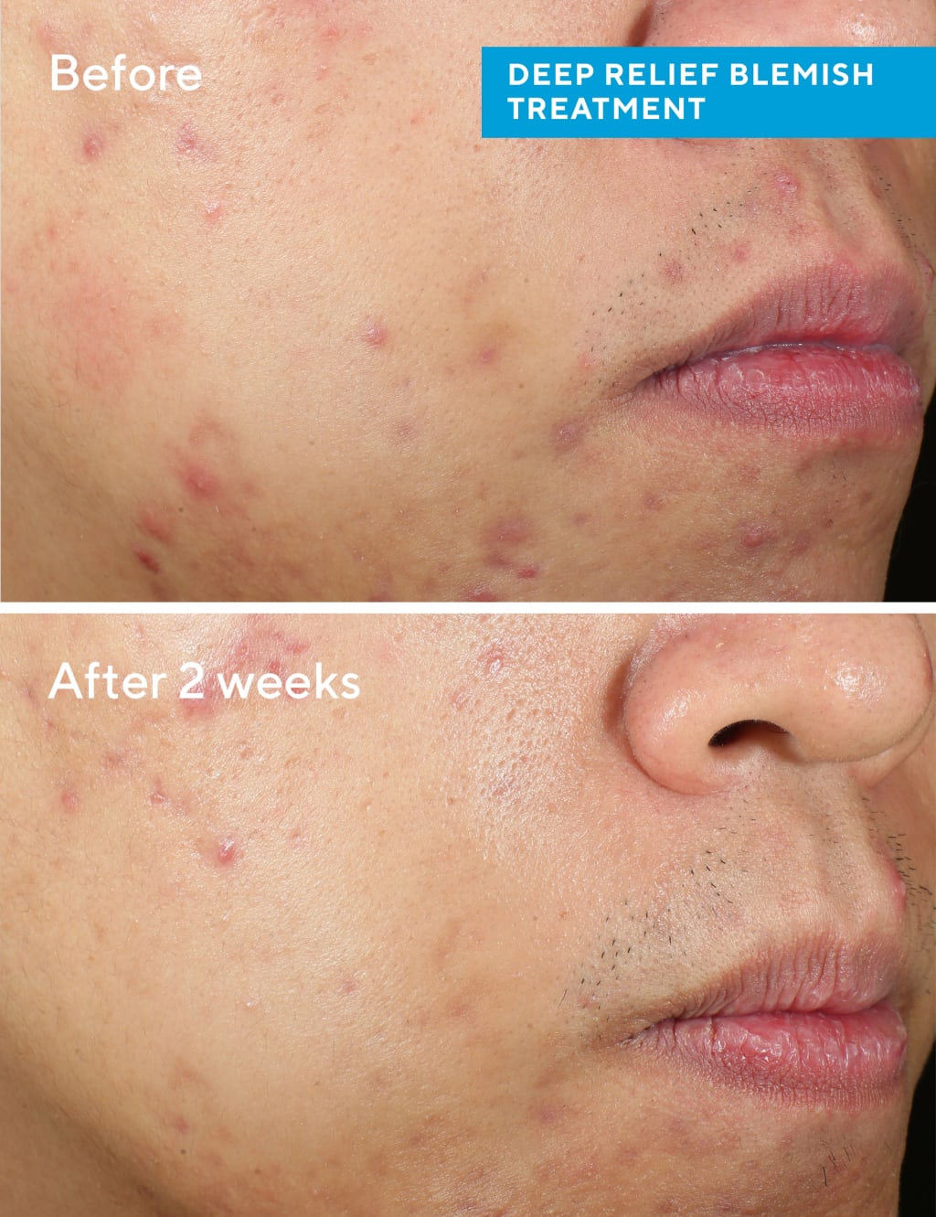 Deep Relief Blemish Treatment 30ml 4 of 7