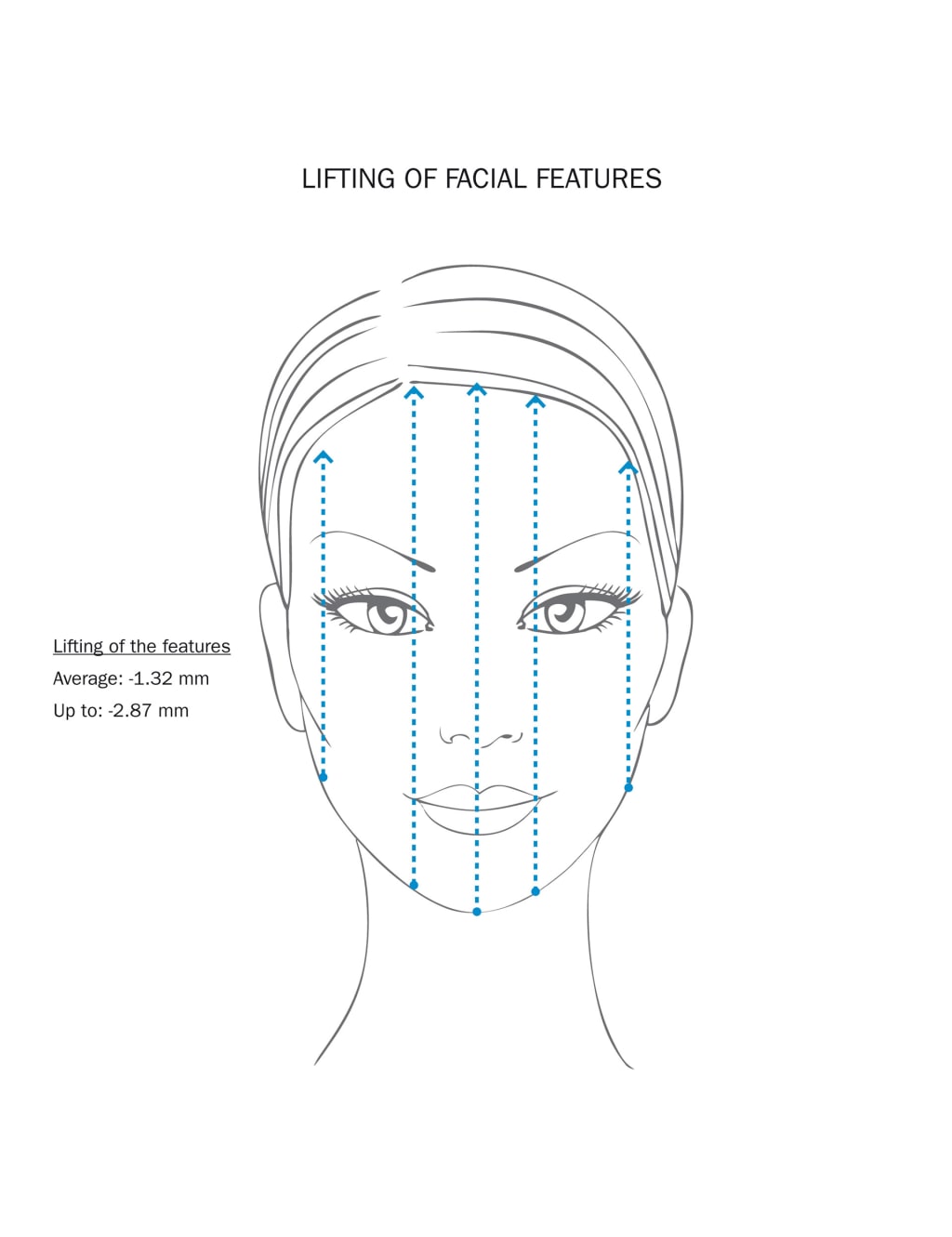 Lip Volume Grade1 5ml 2 of 4