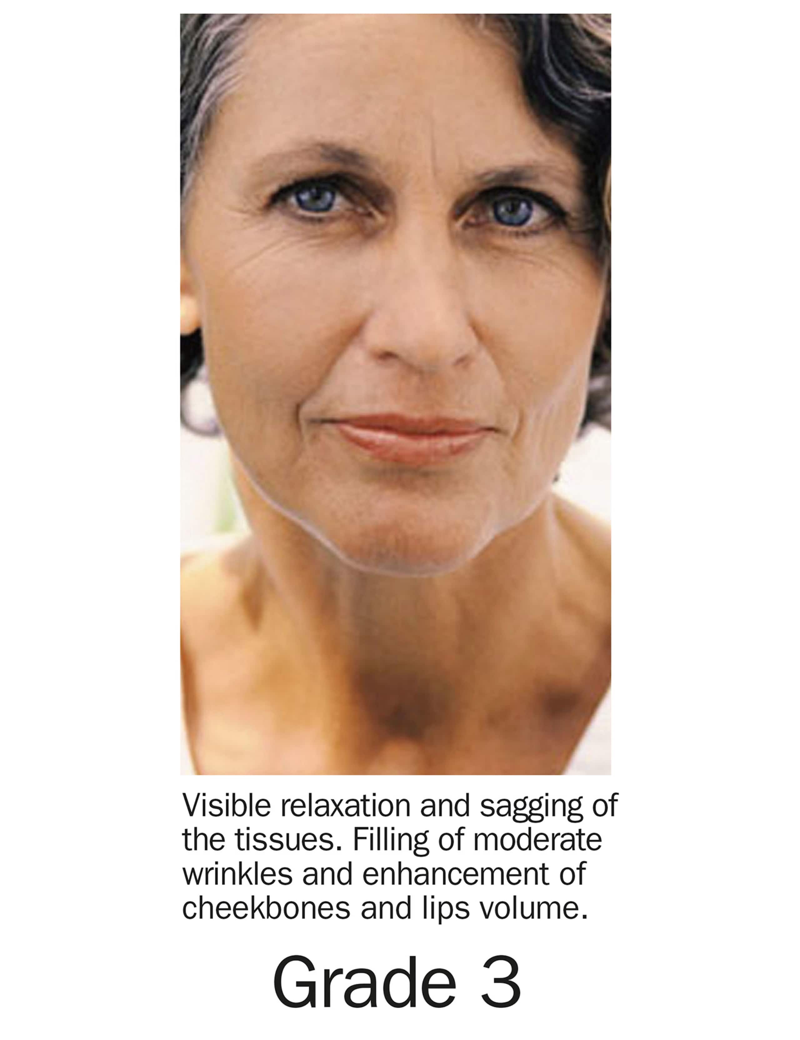 Grade 3 Filler Gel Treatment Kit 4 of 8