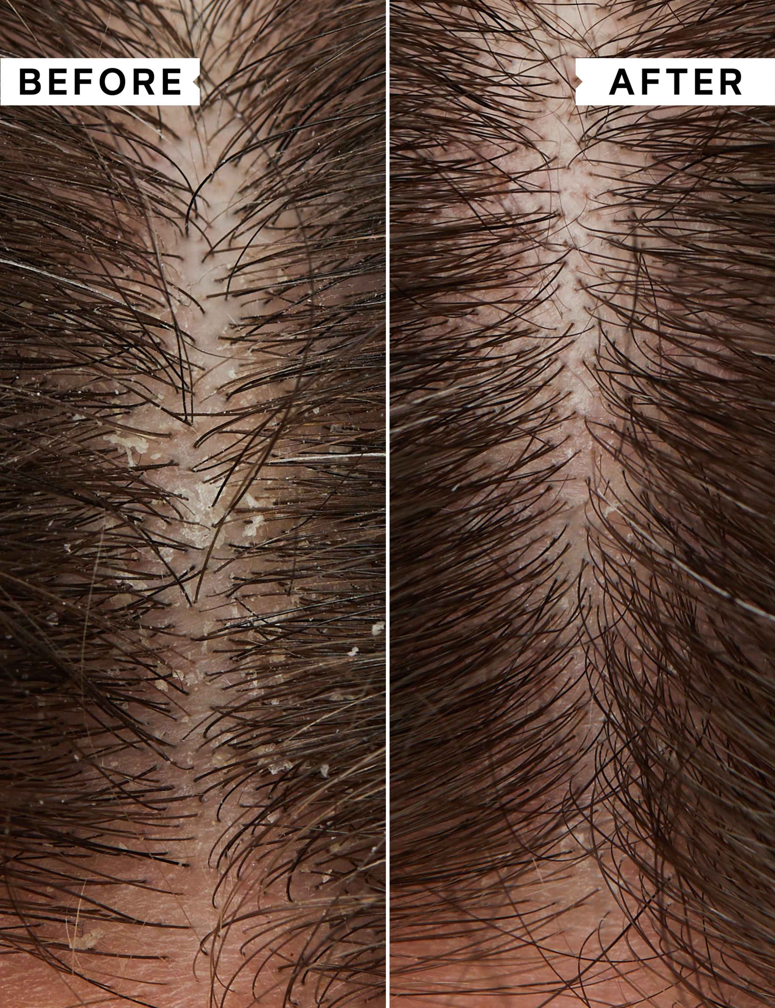 Flaky/Itchy Scalp Regime Kit 4 of 6