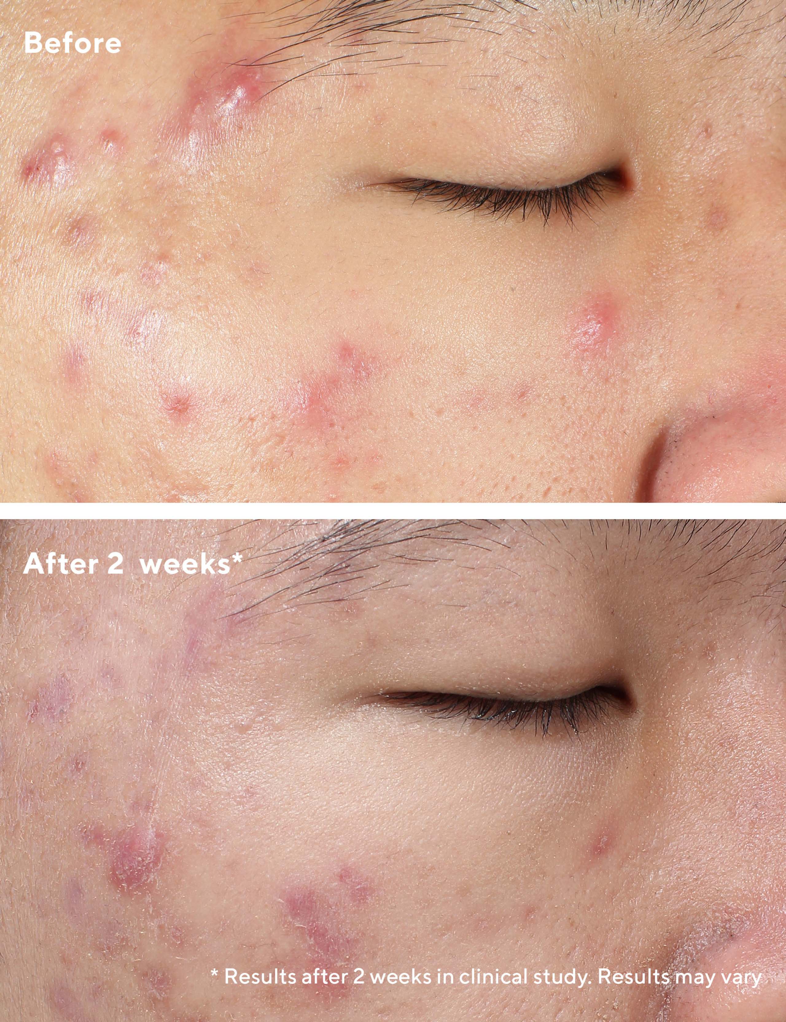 Deep Relief Blemish Treatment 30ml 2 of 7
