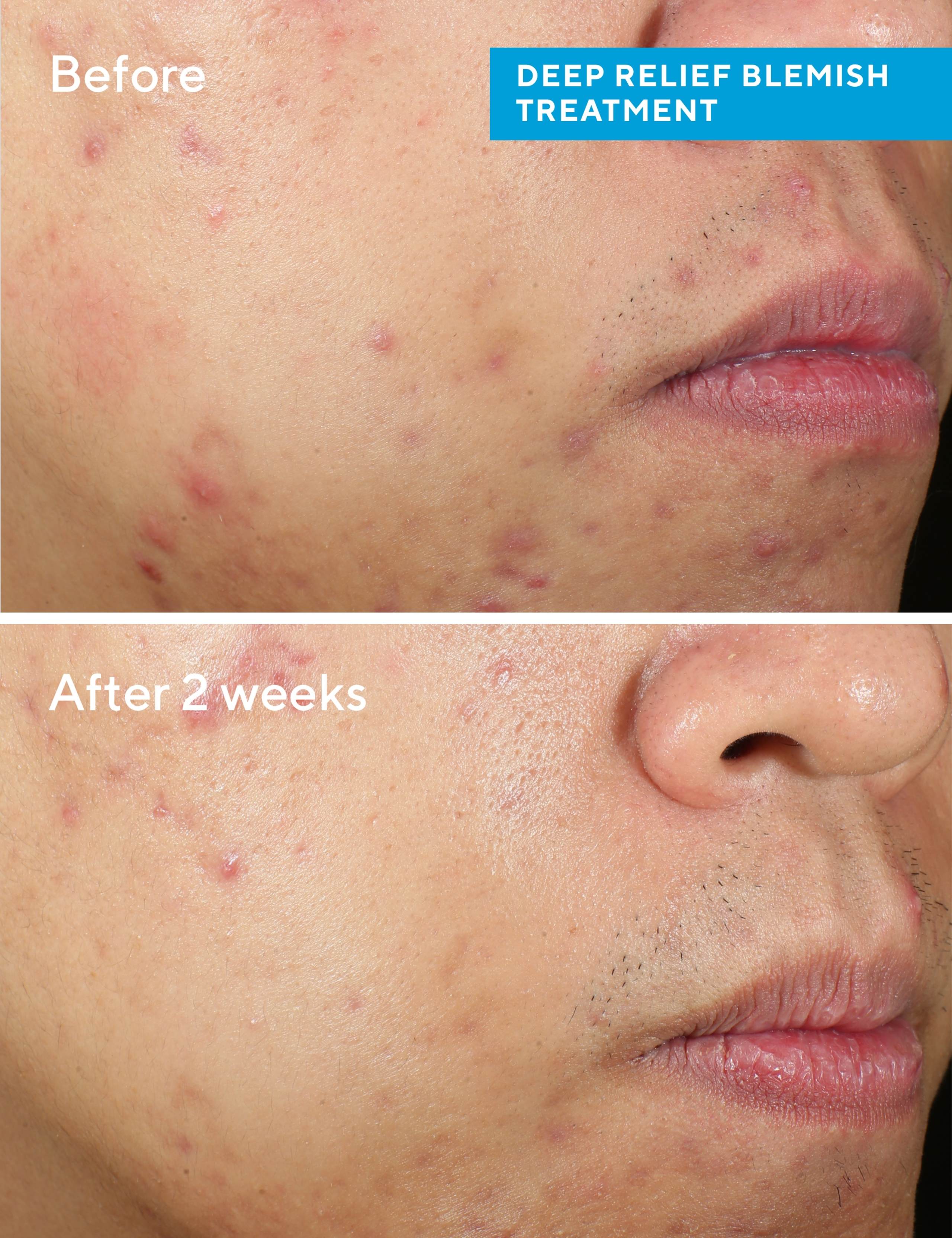Deep Relief Blemish Treatment 30ml 4 of 7